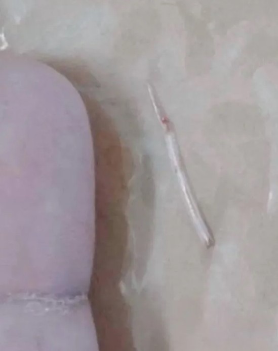 Korku filmlerini aratmayan olay! Yuttuğu balık kılçığı boynunu delip dışarı çıktı